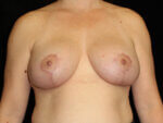 Breast lift with Augmentation - Case 14692 - After