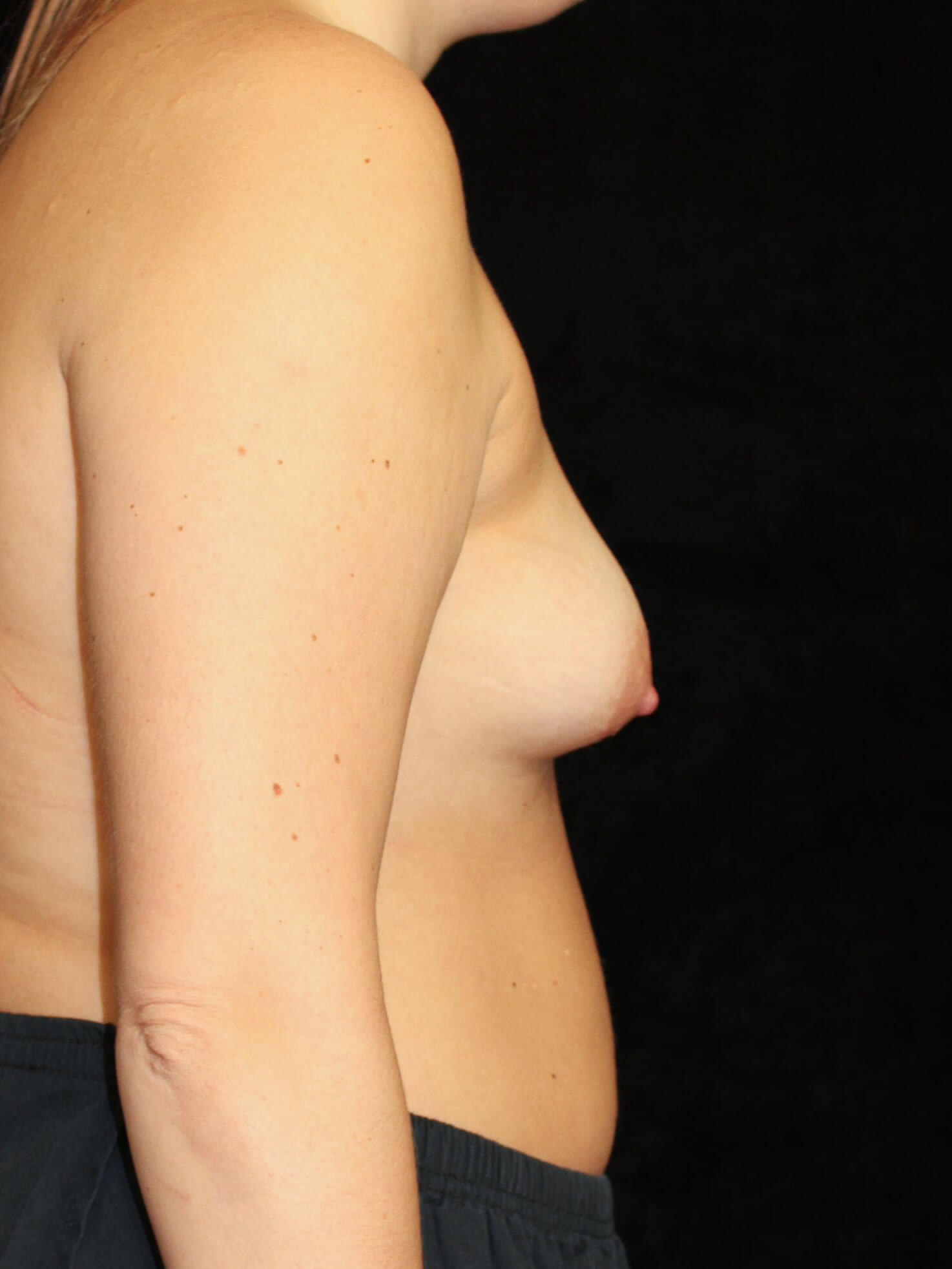 Breast lift with Augmentation before and after results - Nashville patient - before view 3