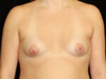 Breast lift with Augmentation - Case 15264 - Before