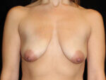 Breast lift with Augmentation - Case 15438 - Before