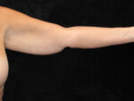 Arm Lift before and after results - Nashville patient - Before