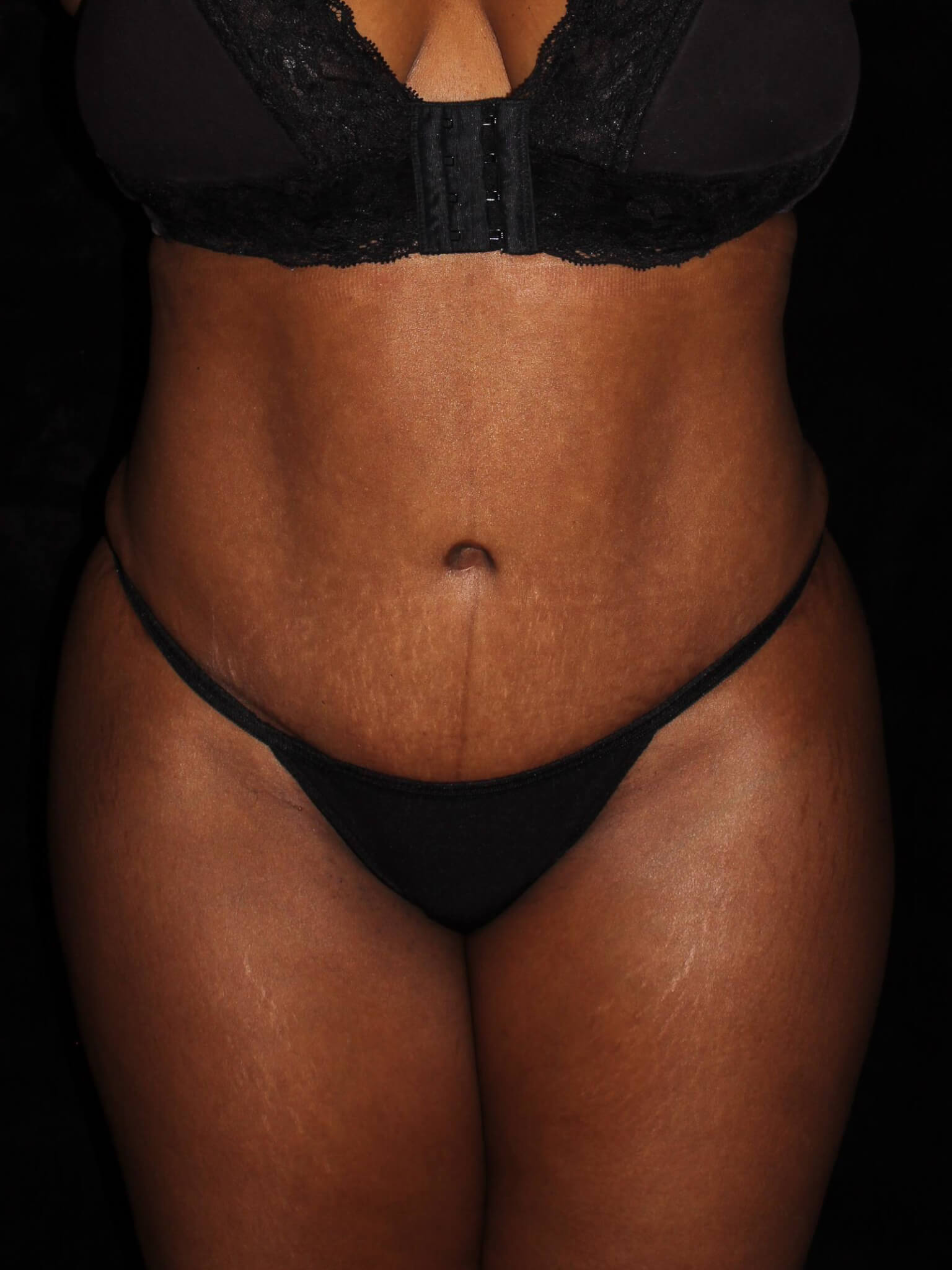 Tummy Tuck Patient Photo - Case 11321 - after view