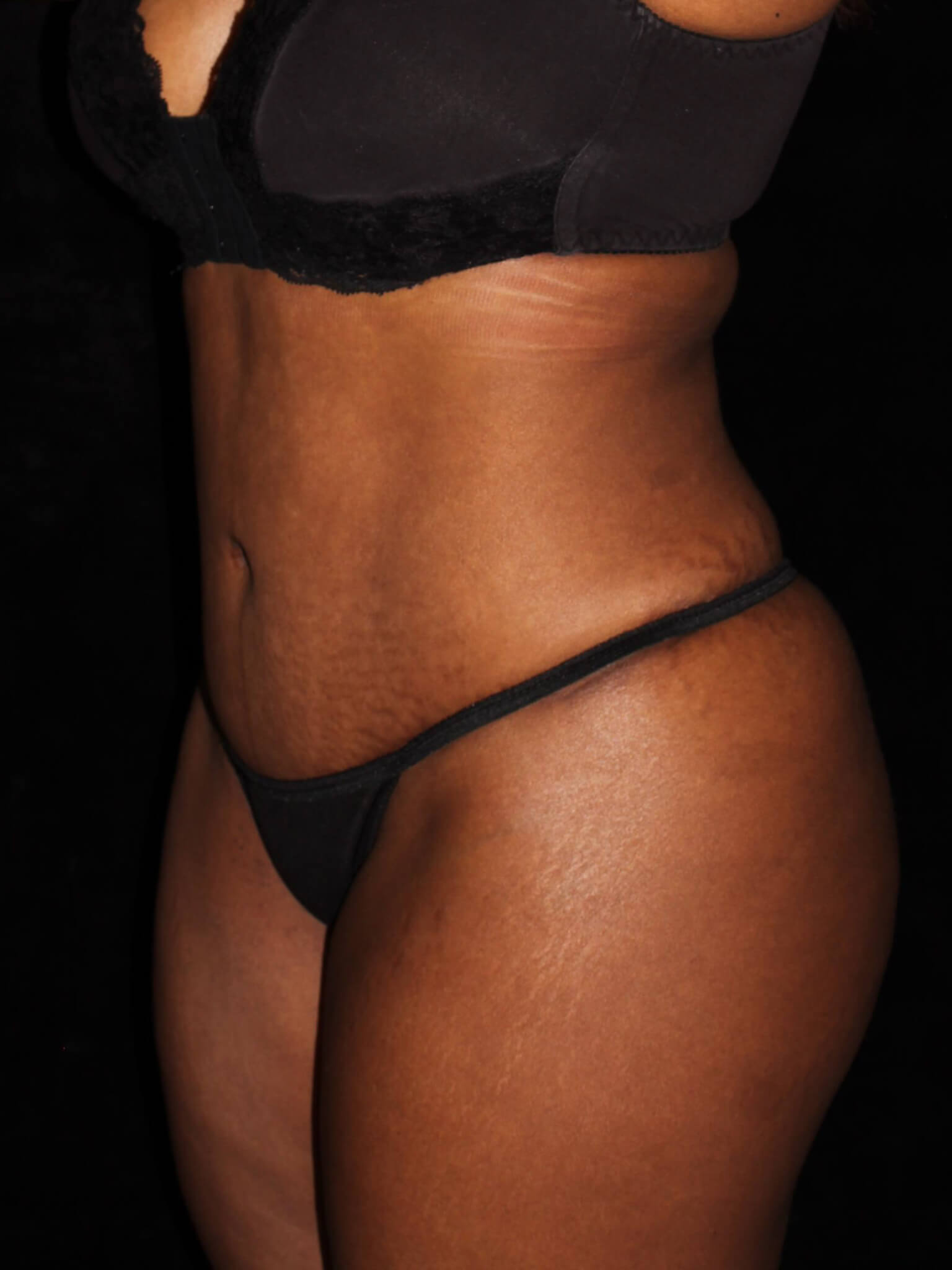 Tummy Tuck Patient Photo - Case 11321 - after view-2