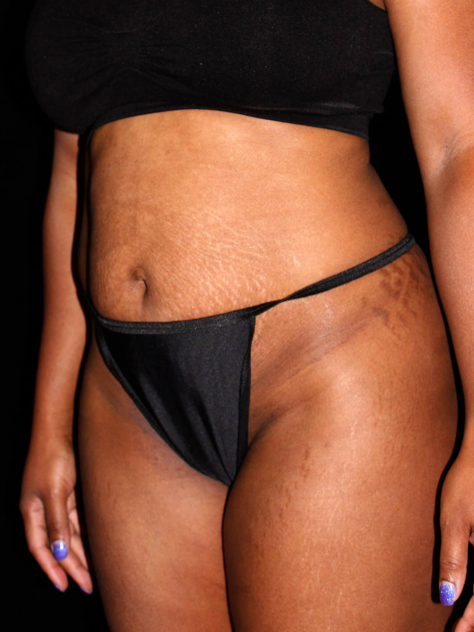 Tummy Tuck Patient Photo - Case 11321 - before view-2