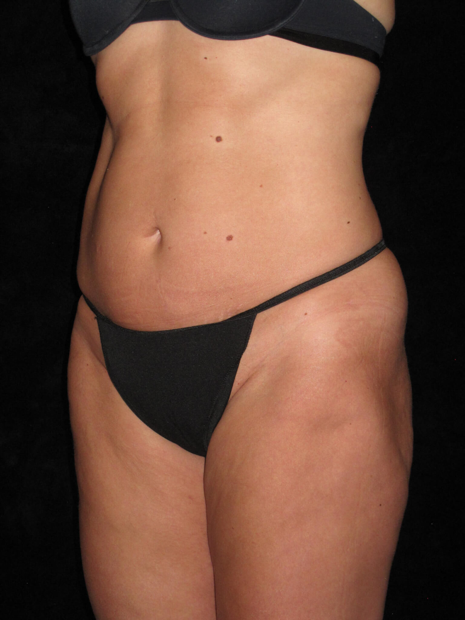 Liposuction before and after results - Nashville patient - after view 2