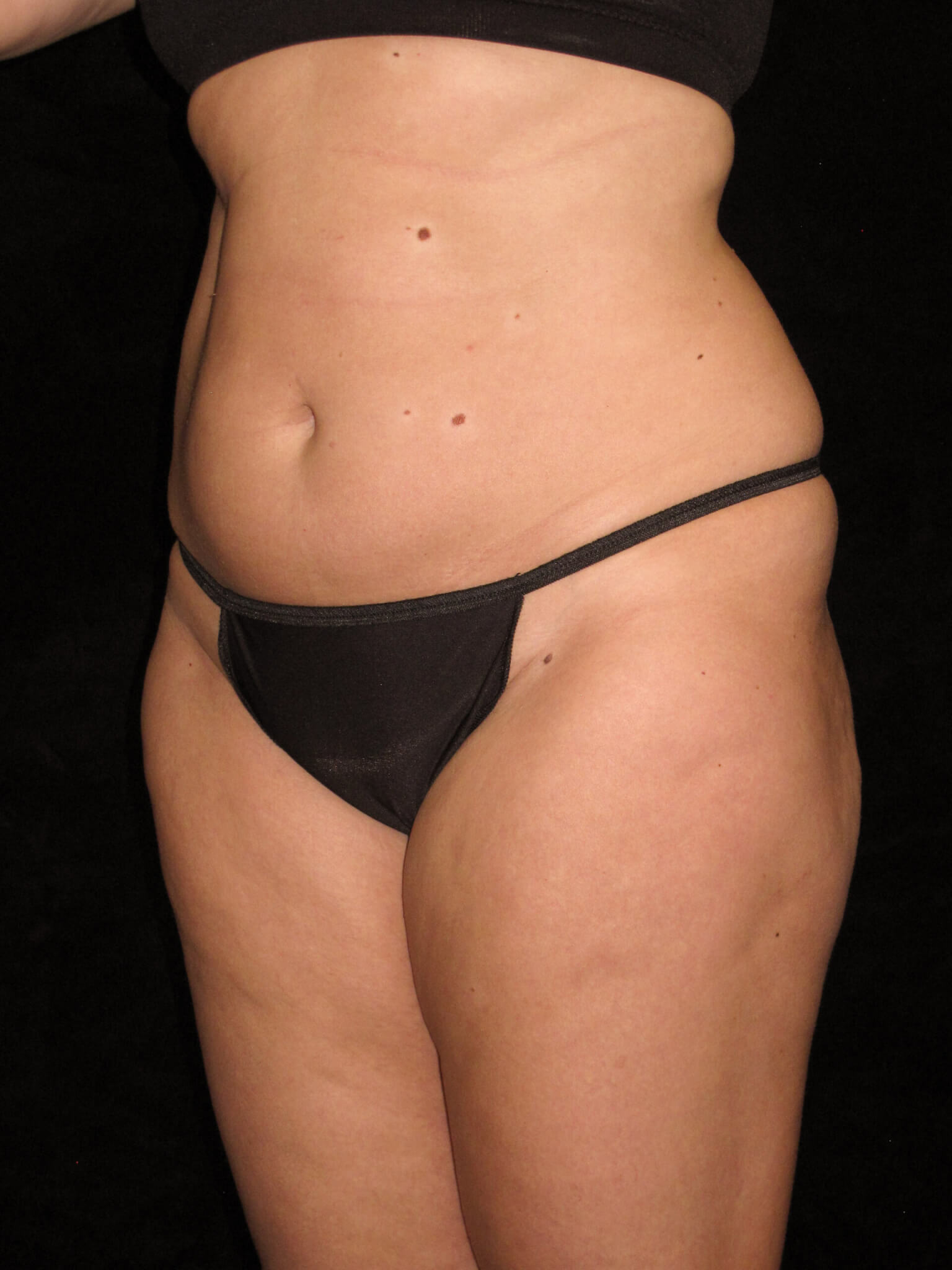 Liposuction before and after results - Nashville patient - before view 2