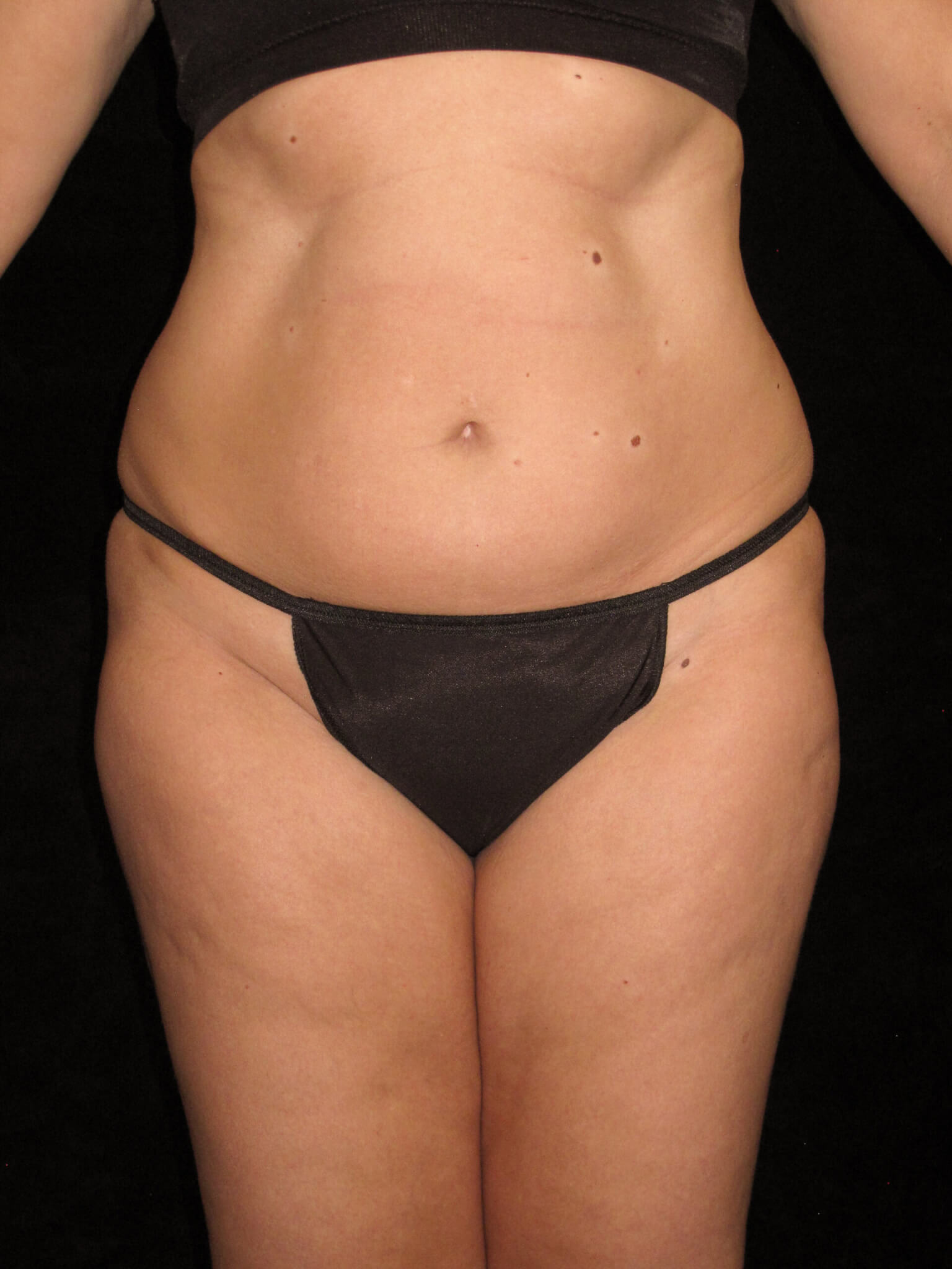 Liposuction before and after results - Nashville patient - before