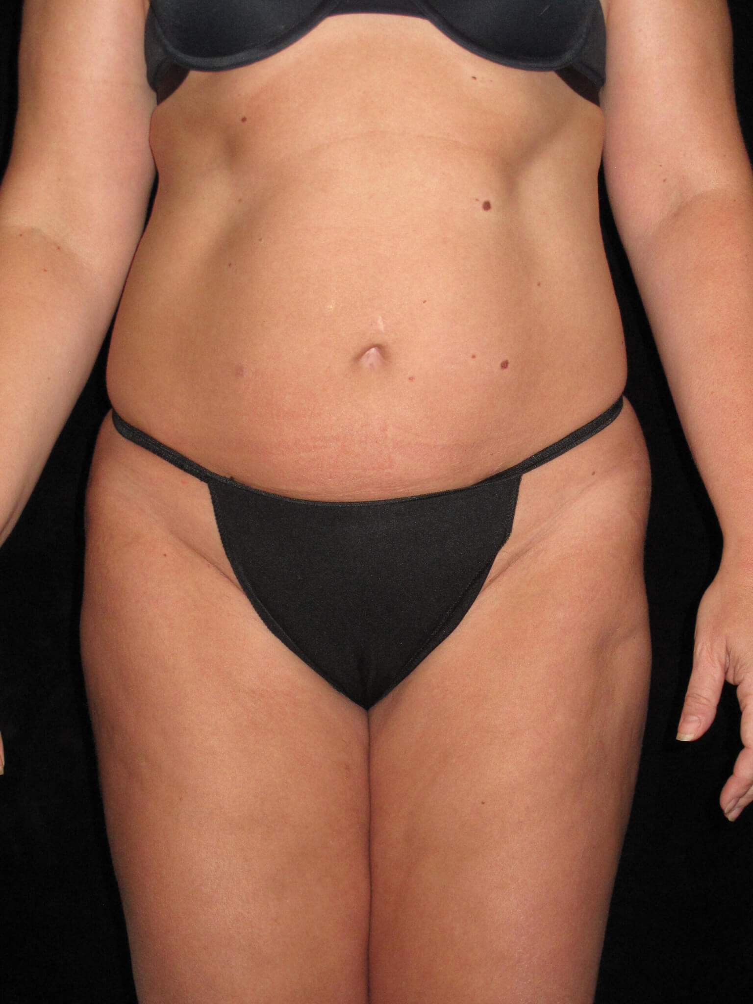 Liposuction before and after results - Nashville patient - after