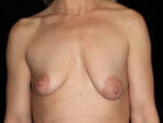 Breast Asymmetry - Case 14895 - Before