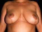 Breast Reduction before and after results - Nashville patient - After