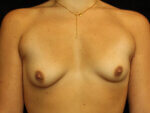 Breast Asymmetry - Case 15913 - Before
