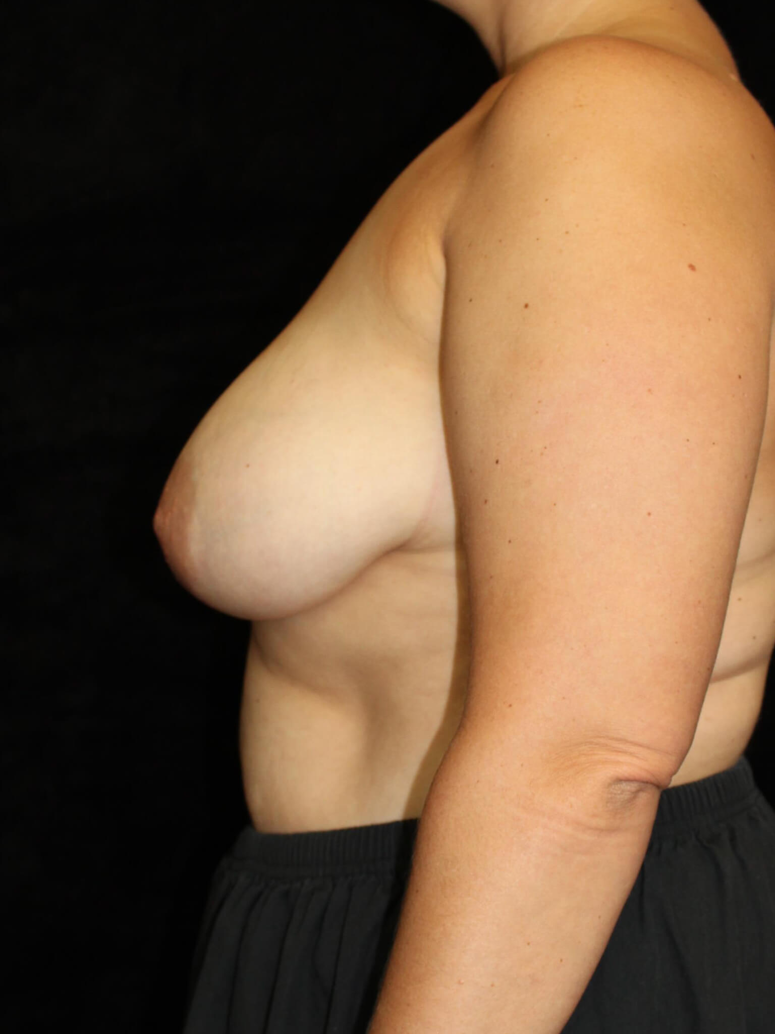 Breast Lift Patient Photo - Case 15048 - before view-2