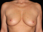 Breast Augmentation before and after results - Nashville patient - Before
