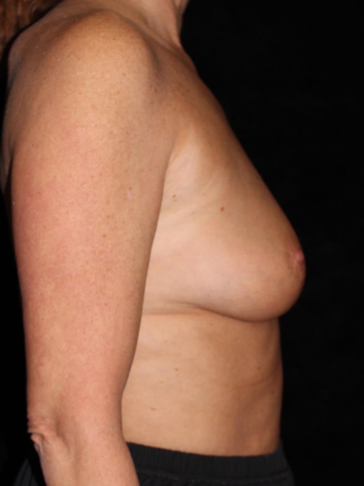 Breast Augmentation Patient Photo - Case 13894 - before view-2