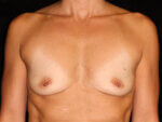 Breast Augmentation before and after results - Nashville patient - Before