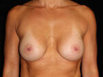 Breast Augmentation before and after results - Nashville patient - After