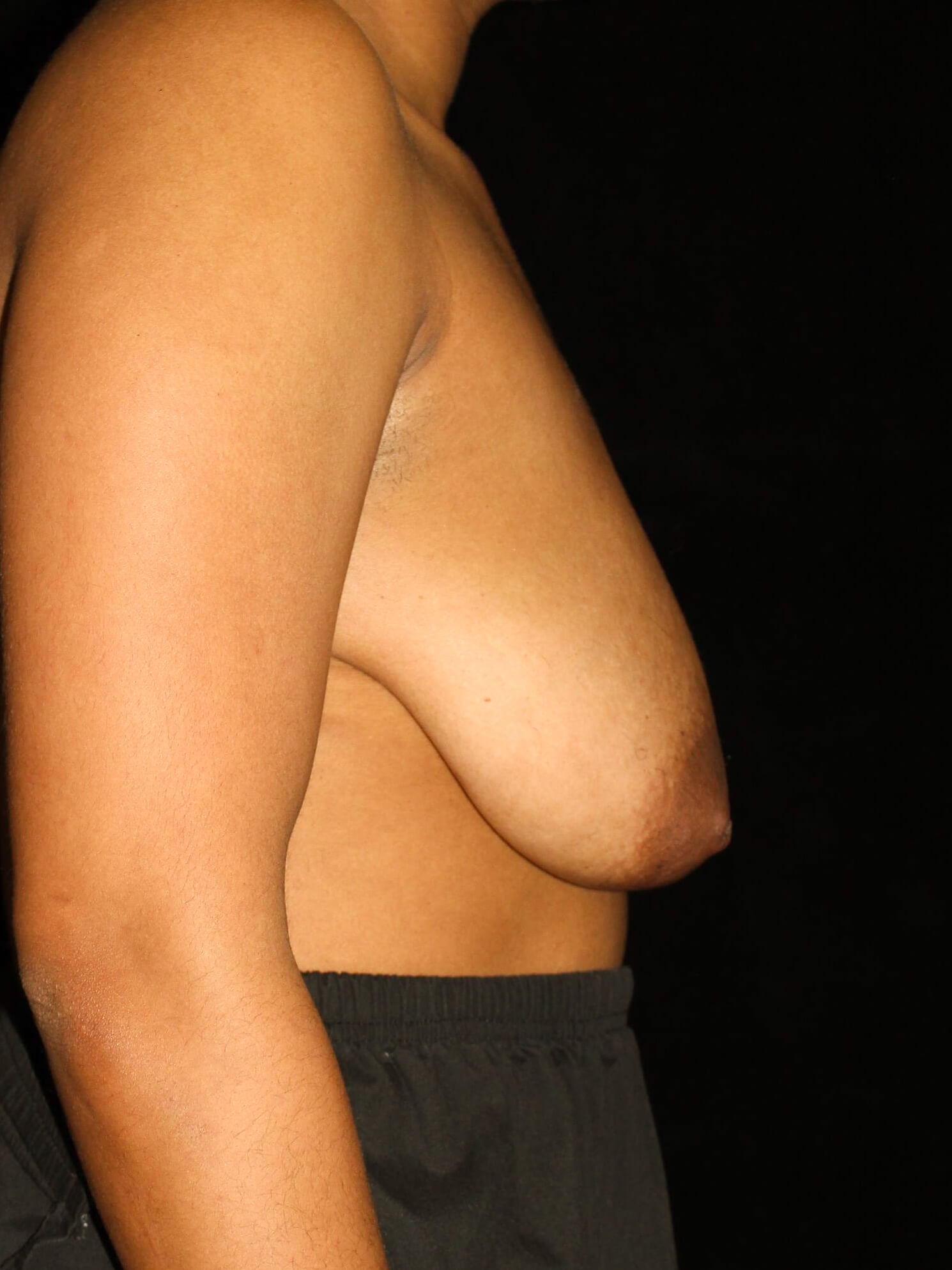 Breast Lift Patient Photo - Case 14507 - before view-2