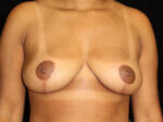 Breast Lift - Case 14507 - After
