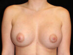 Breast Augmentation before and after results - Nashville patient - After