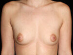 Breast Augmentation before and after results - Nashville patient - Before