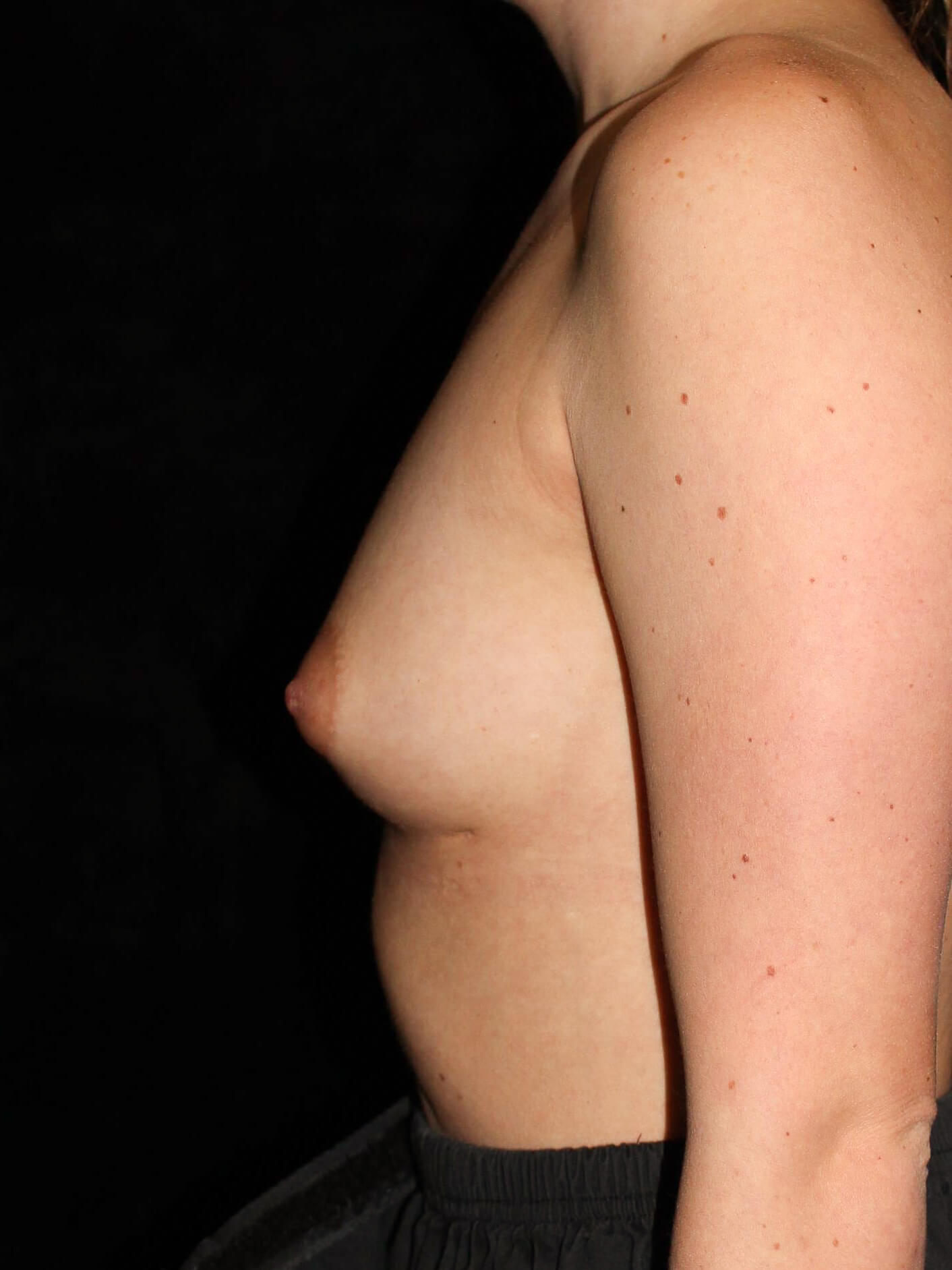 Breast Augmentation before and after results - Nashville patient - before view 3