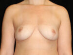 Breast Revision - Case 15007 - Before