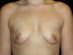 Breast Augmentation before and after results - Nashville patient - Before