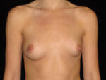 Breast Asymmetry - Case 13219 - Before