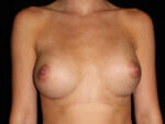 Breast Asymmetry - Case 13219 - After