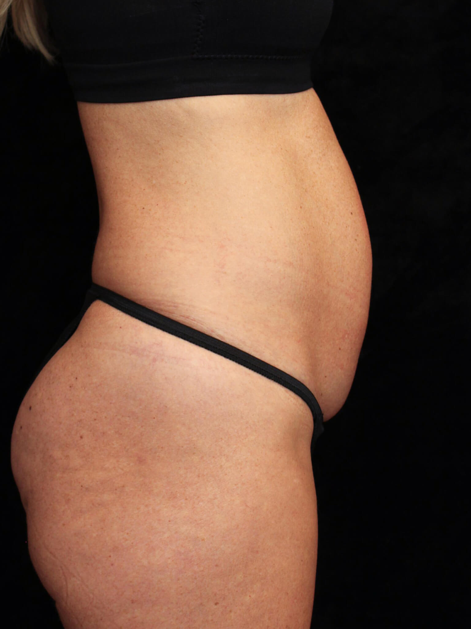 Tummy Tuck Patient Photo - Case 15816 - before view-