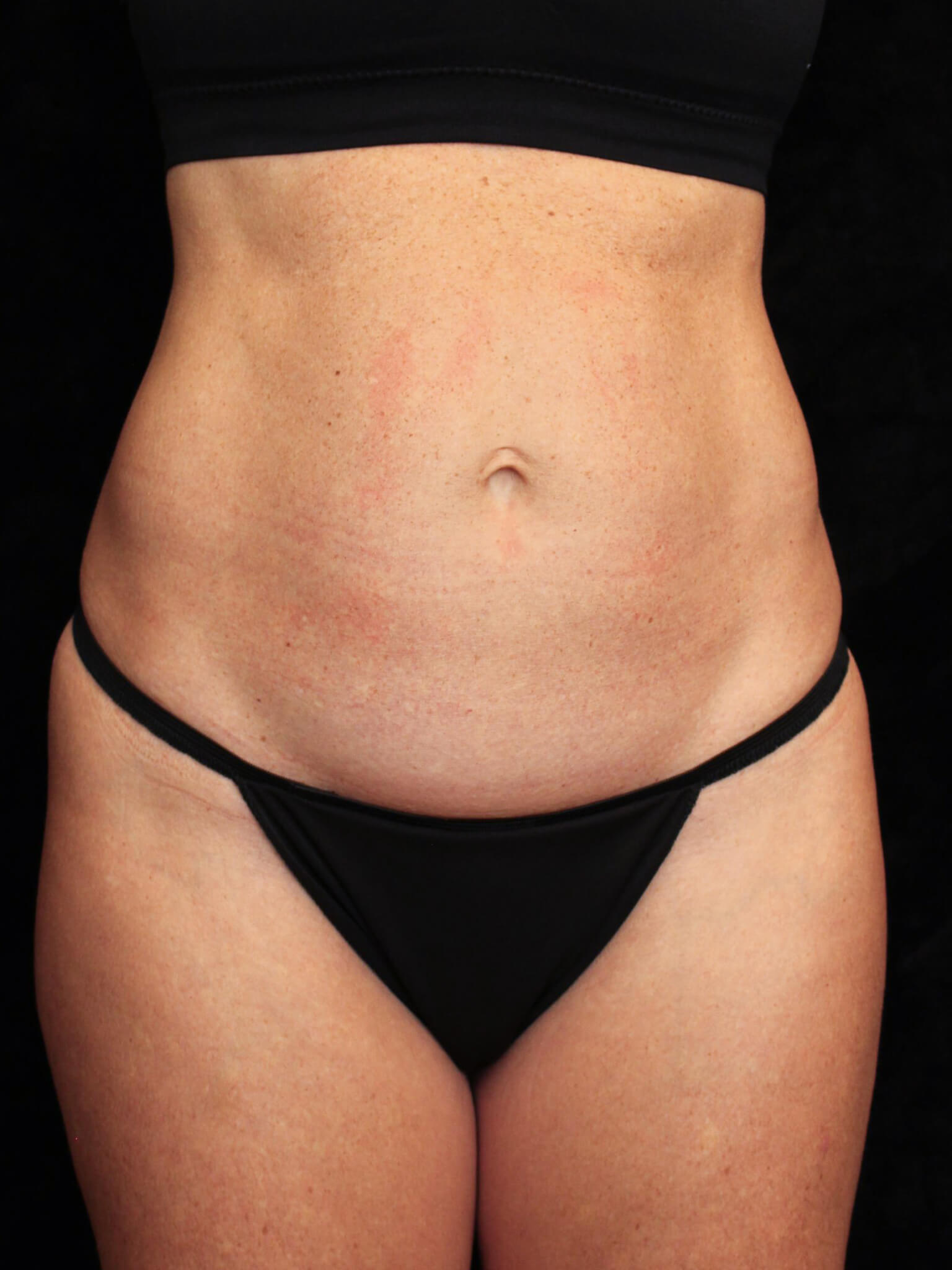 Tummy Tuck Patient Photo - Case 15816 - before view-2