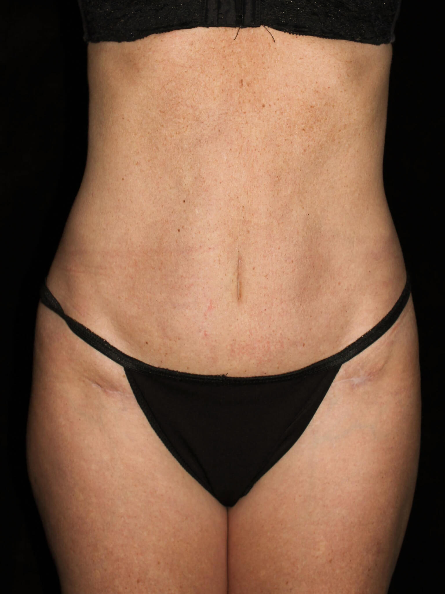 Tummy Tuck Patient Photo - Case 15816 - after view-2