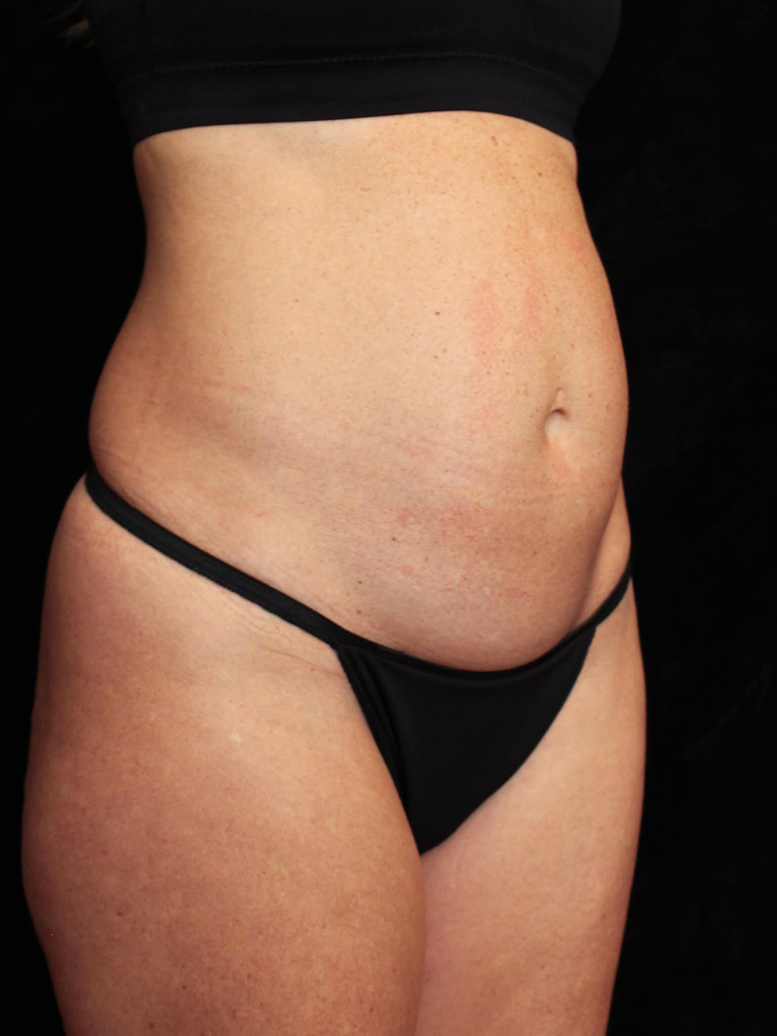 Tummy Tuck Patient Photo - Case 15816 - before view-1