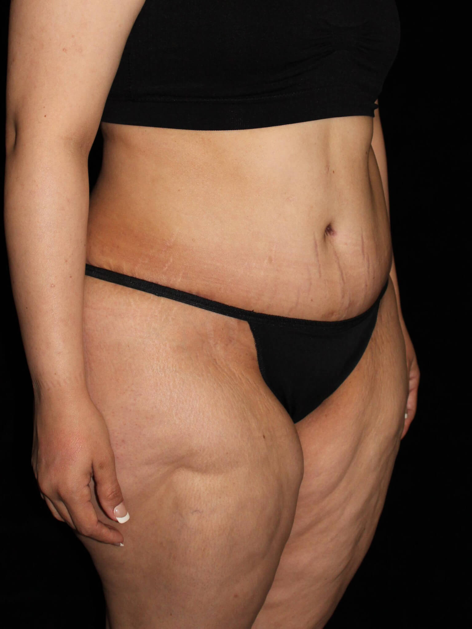 Tummy Tuck Patient Photo - Case 13866 - after view-1