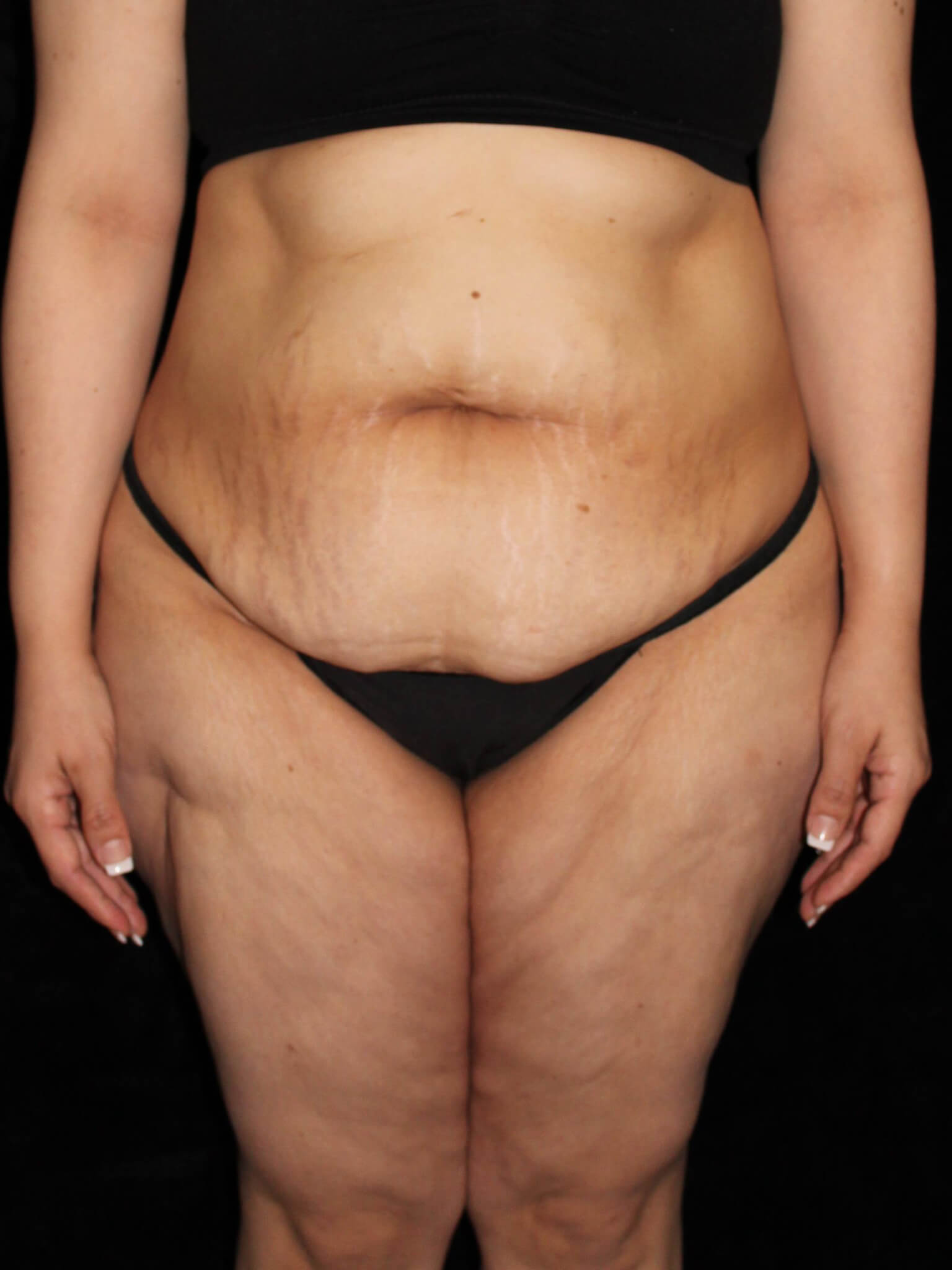 Tummy Tuck Patient Photo - Case 13866 - before view-