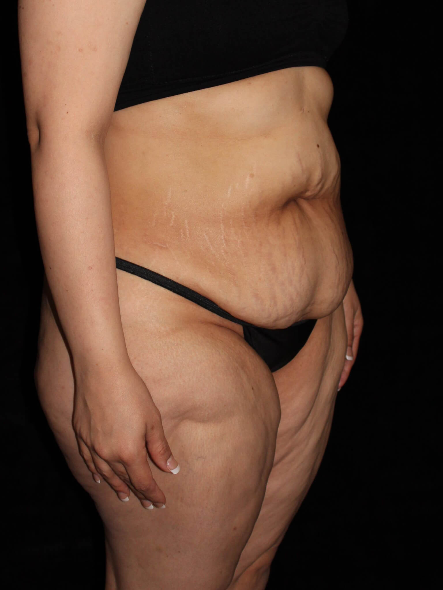 Tummy Tuck Patient Photo - Case 13866 - before view-1