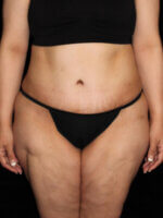 Tummy Tuck - Case 13866 - After