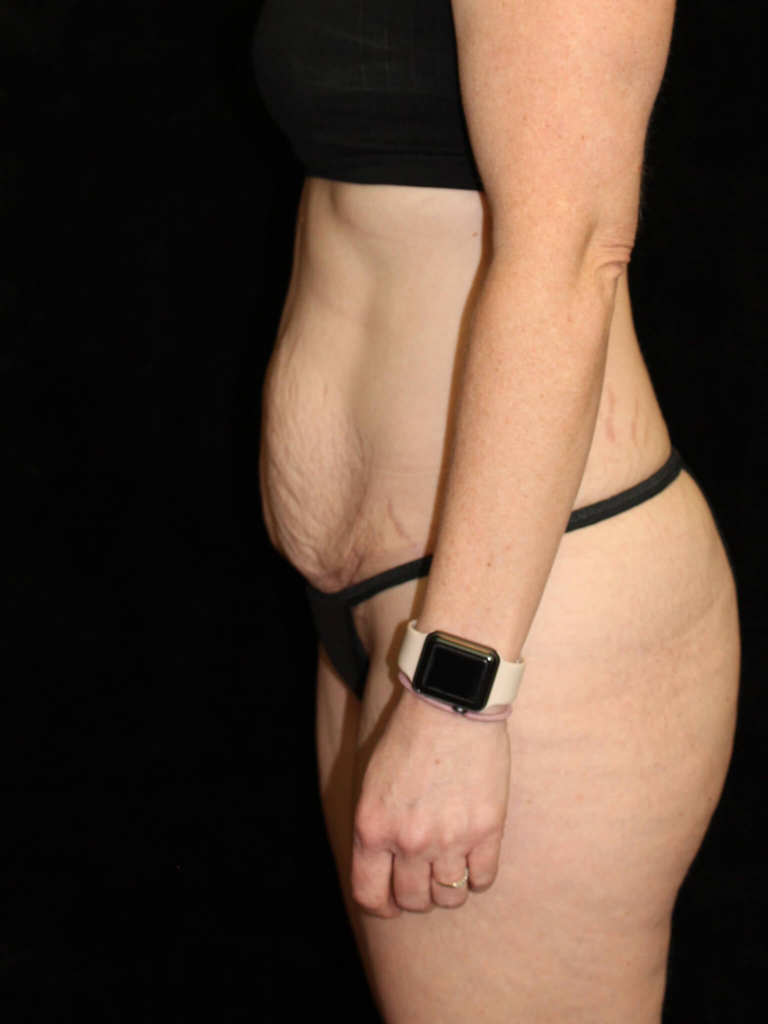 Tummy Tuck Patient Photo - Case 15493 - before view-2