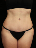 Tummy Tuck - Case 15493 - After