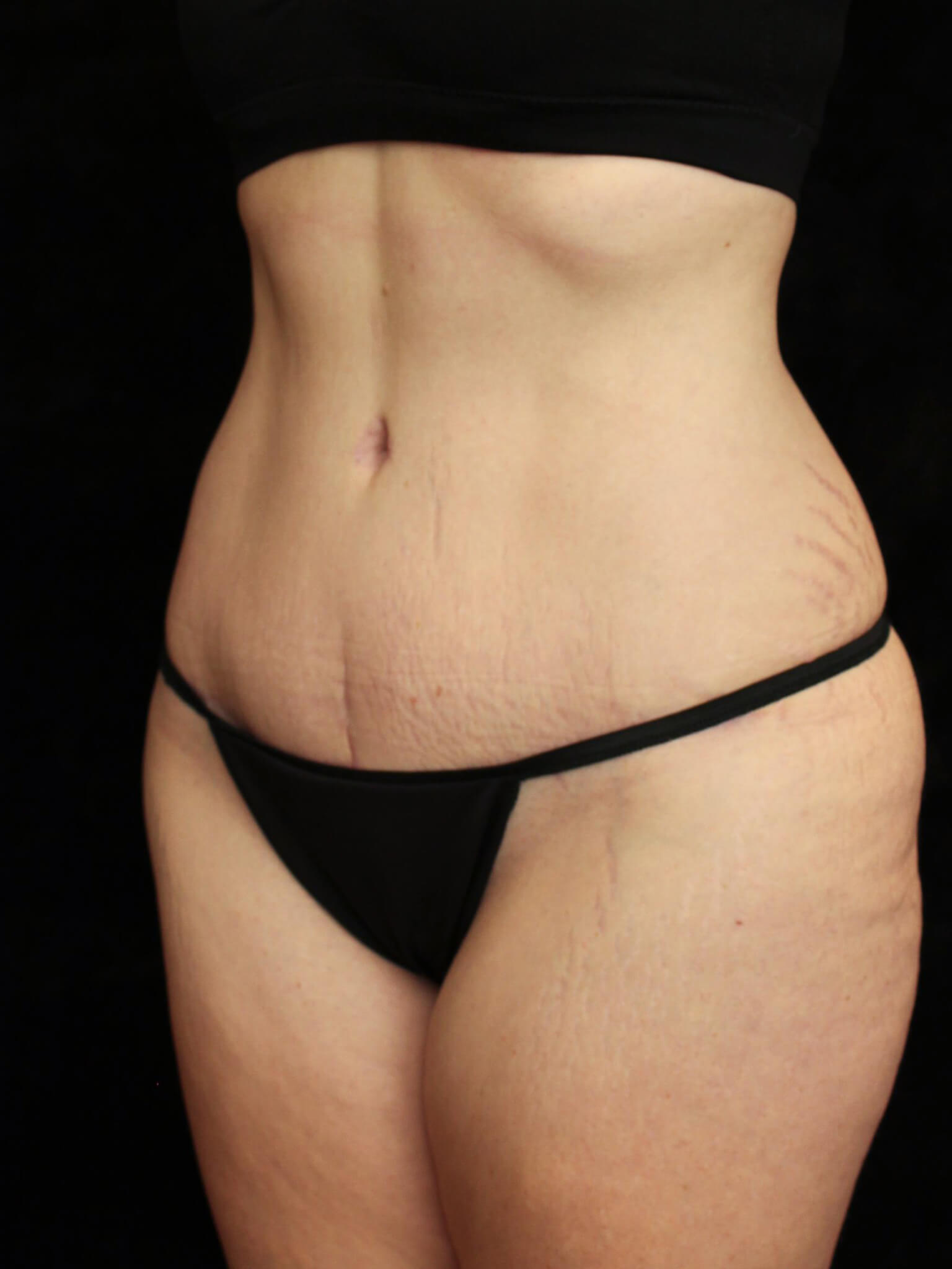 Tummy Tuck Patient Photo - Case 15493 - after view-1