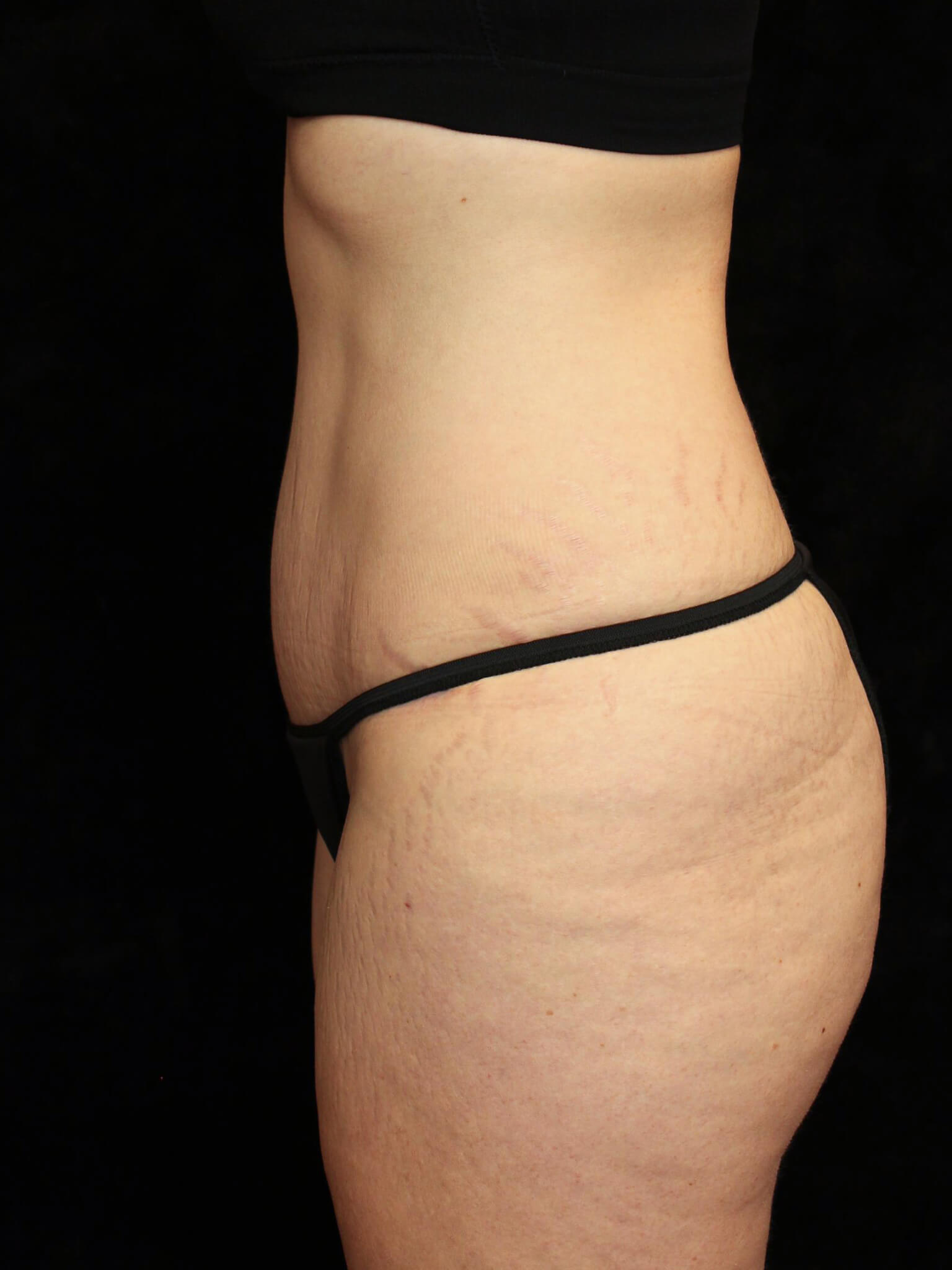 Tummy Tuck Patient Photo - Case 15493 - after view-2