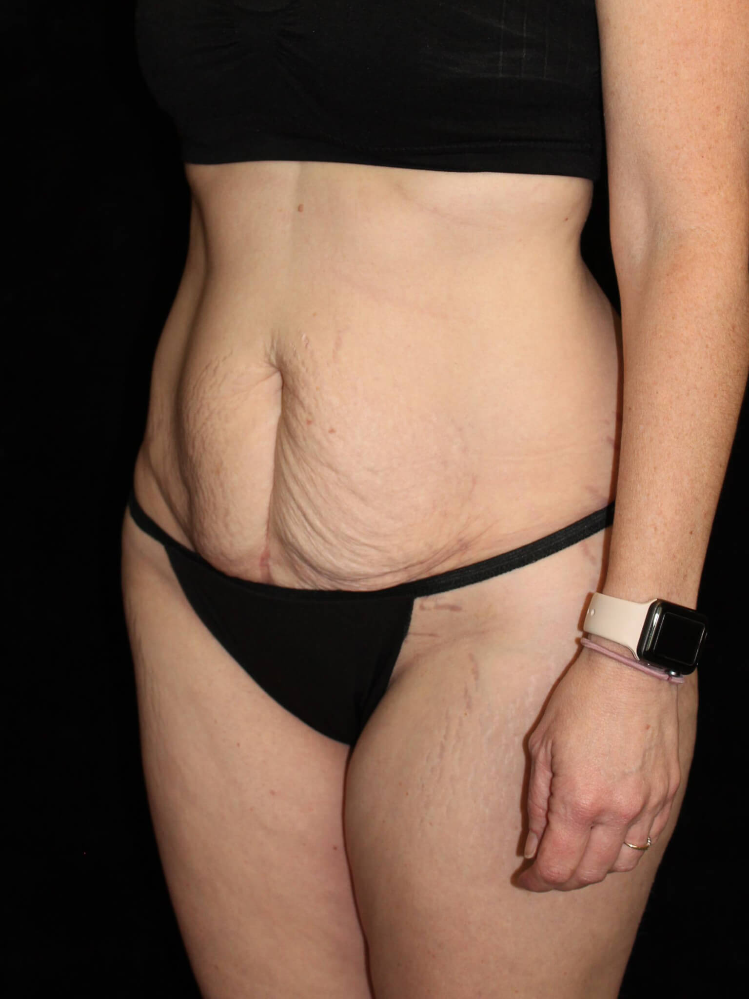 Tummy Tuck Patient Photo - Case 15493 - before view-1