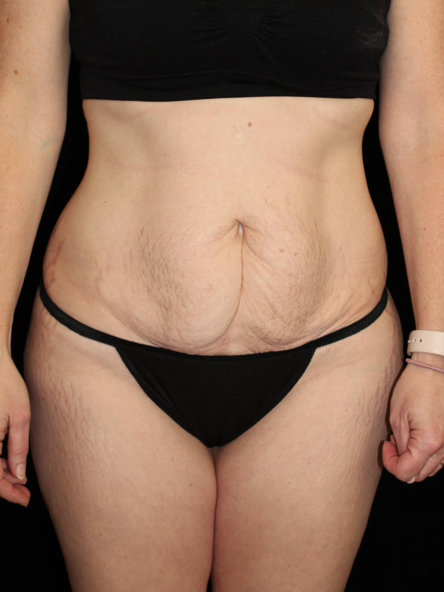 Tummy Tuck Patient Photo - Case 15493 - before view-