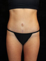 Liposuction before and after results - Nashville patient - After
