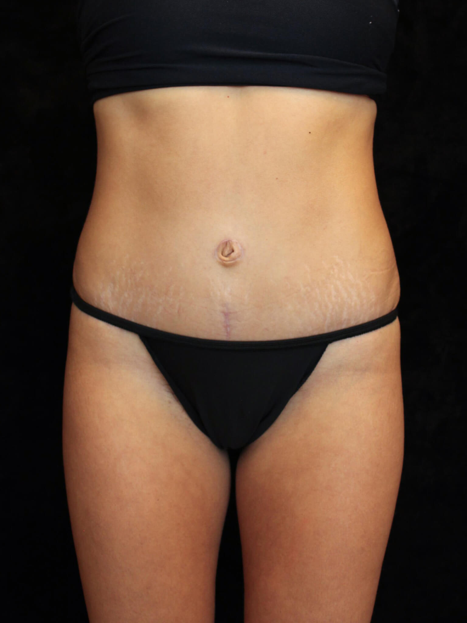 Liposuction Patient Photo - Case 15611 - after view