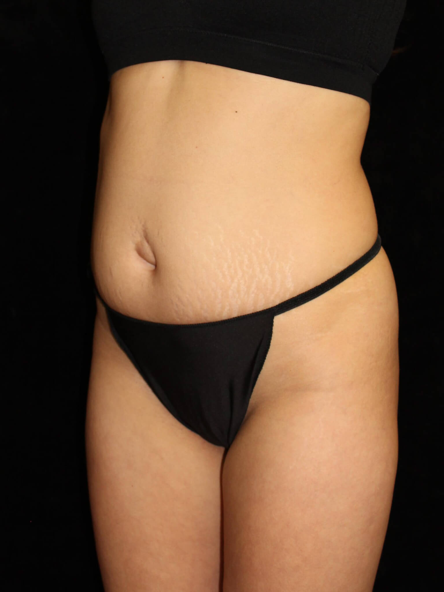 Liposuction Patient Photo - Case 15611 - before view-1