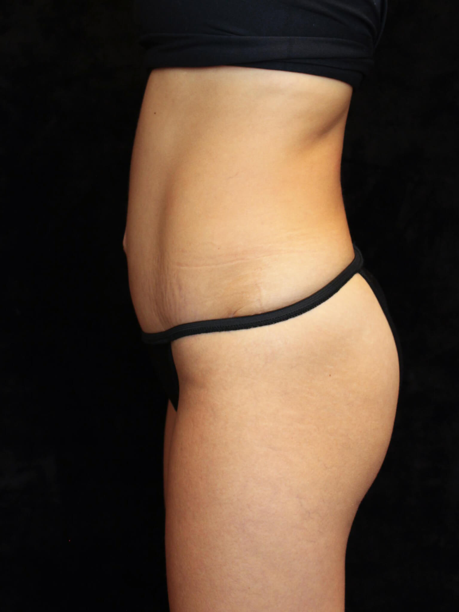 Liposuction Patient Photo - Case 15611 - after view-2