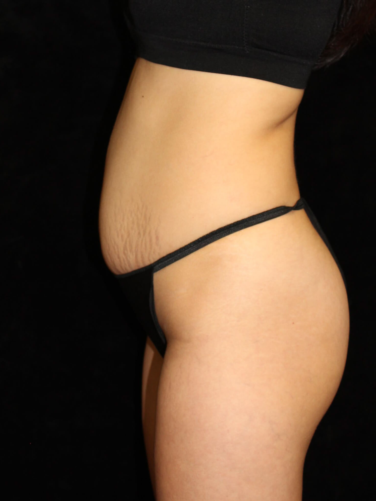 Liposuction Patient Photo - Case 15611 - before view-2