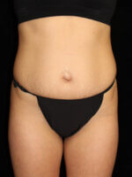 Liposuction before and after results - Nashville patient - Before