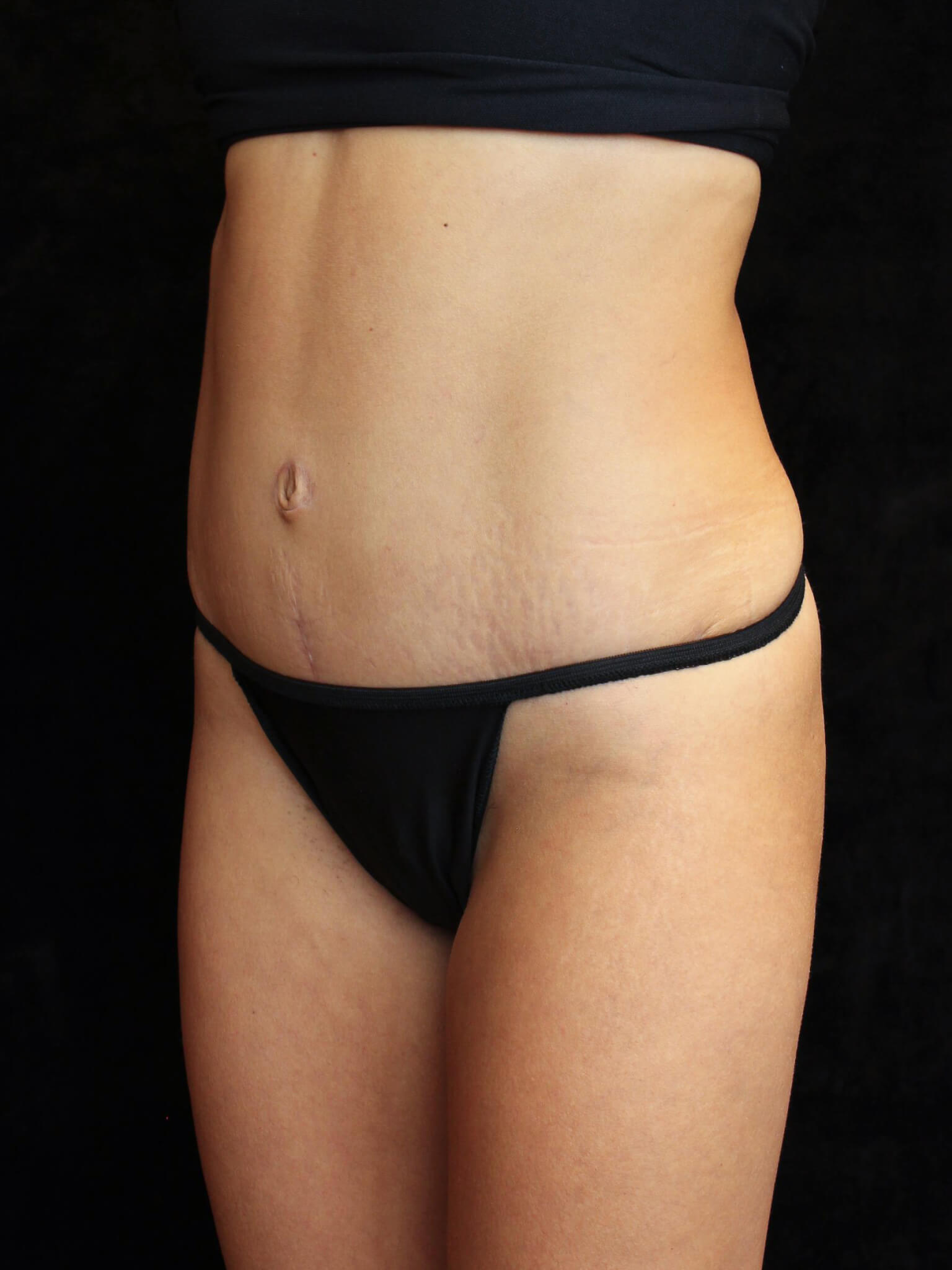 Liposuction Patient Photo - Case 15611 - after view-1